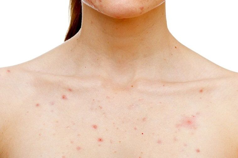 Typical Acne Medications Can't Cure Fungal Acne
