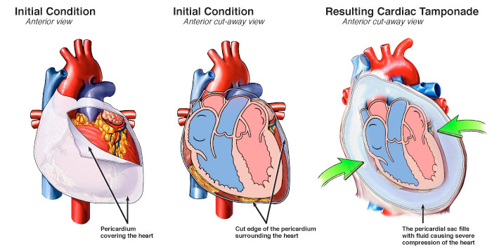 How To Treat Cardiac Tamponade – Cure Cardiac Paradoxus